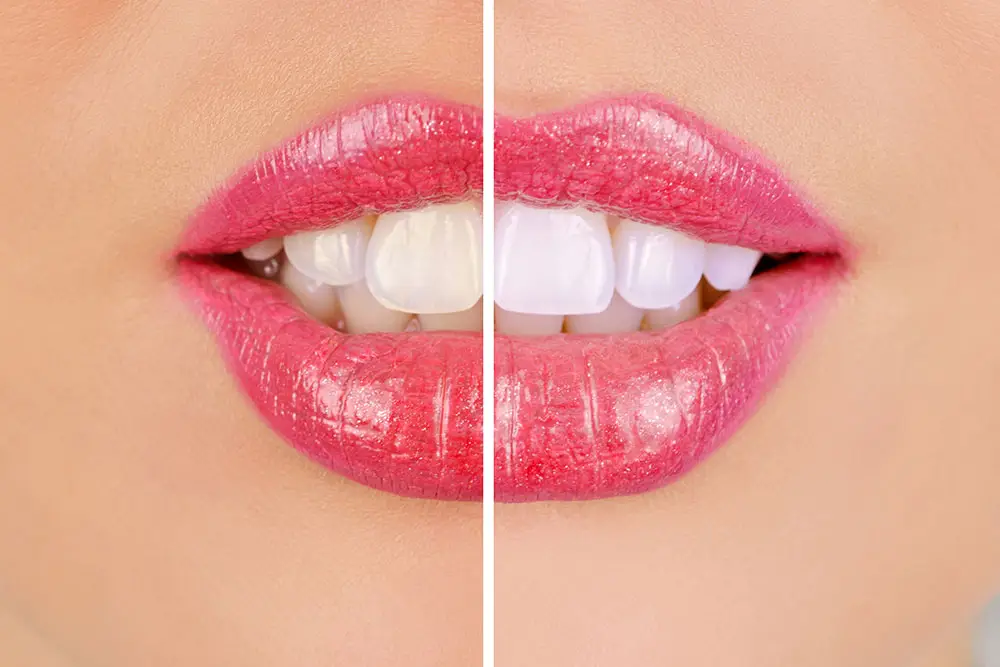 woman getting her teeth whitened